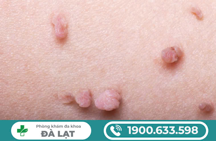 NỔI MỤN THỊT Ở VÙNG KÍN NAM